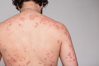 What is psoriasis?