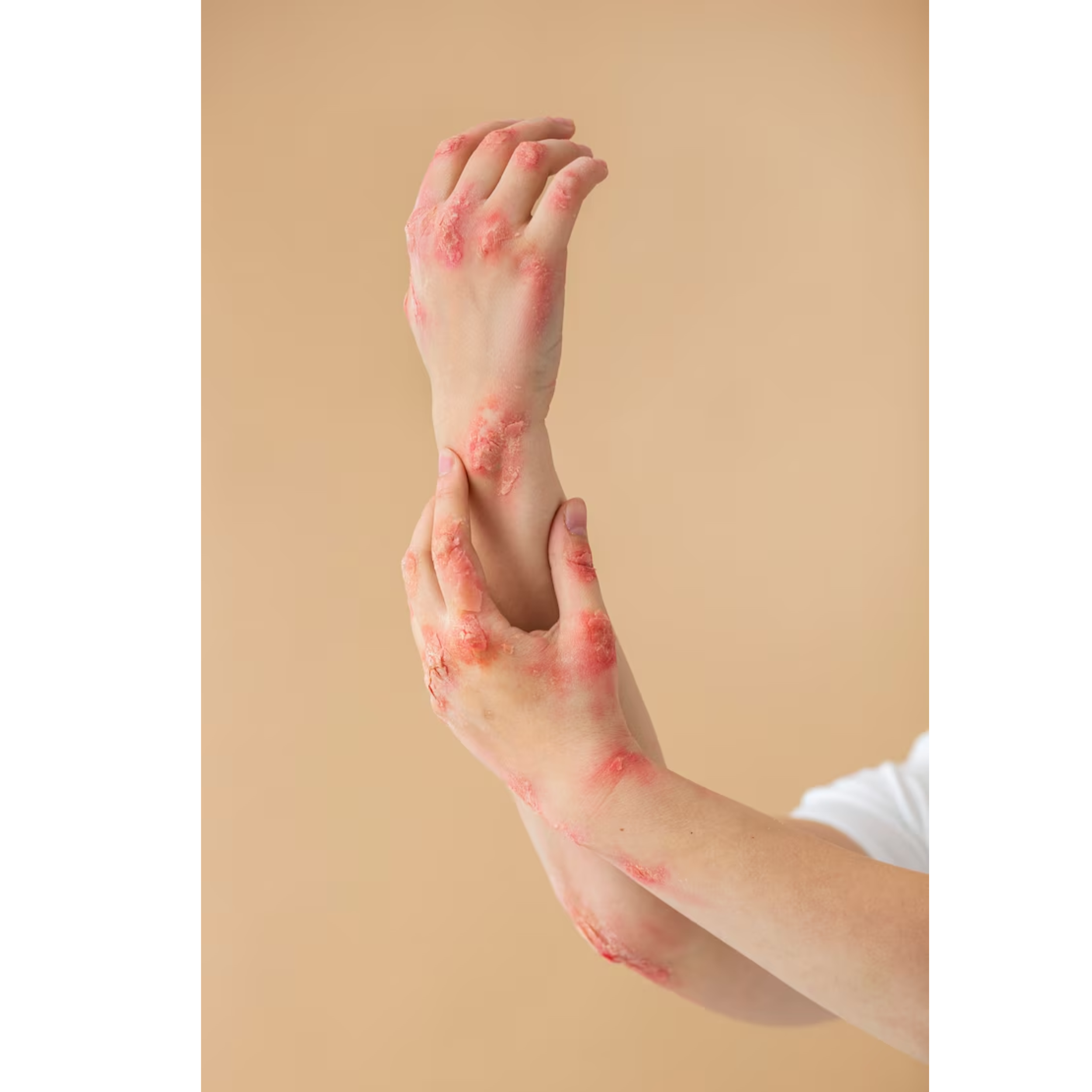 Acid Peptic Disease 