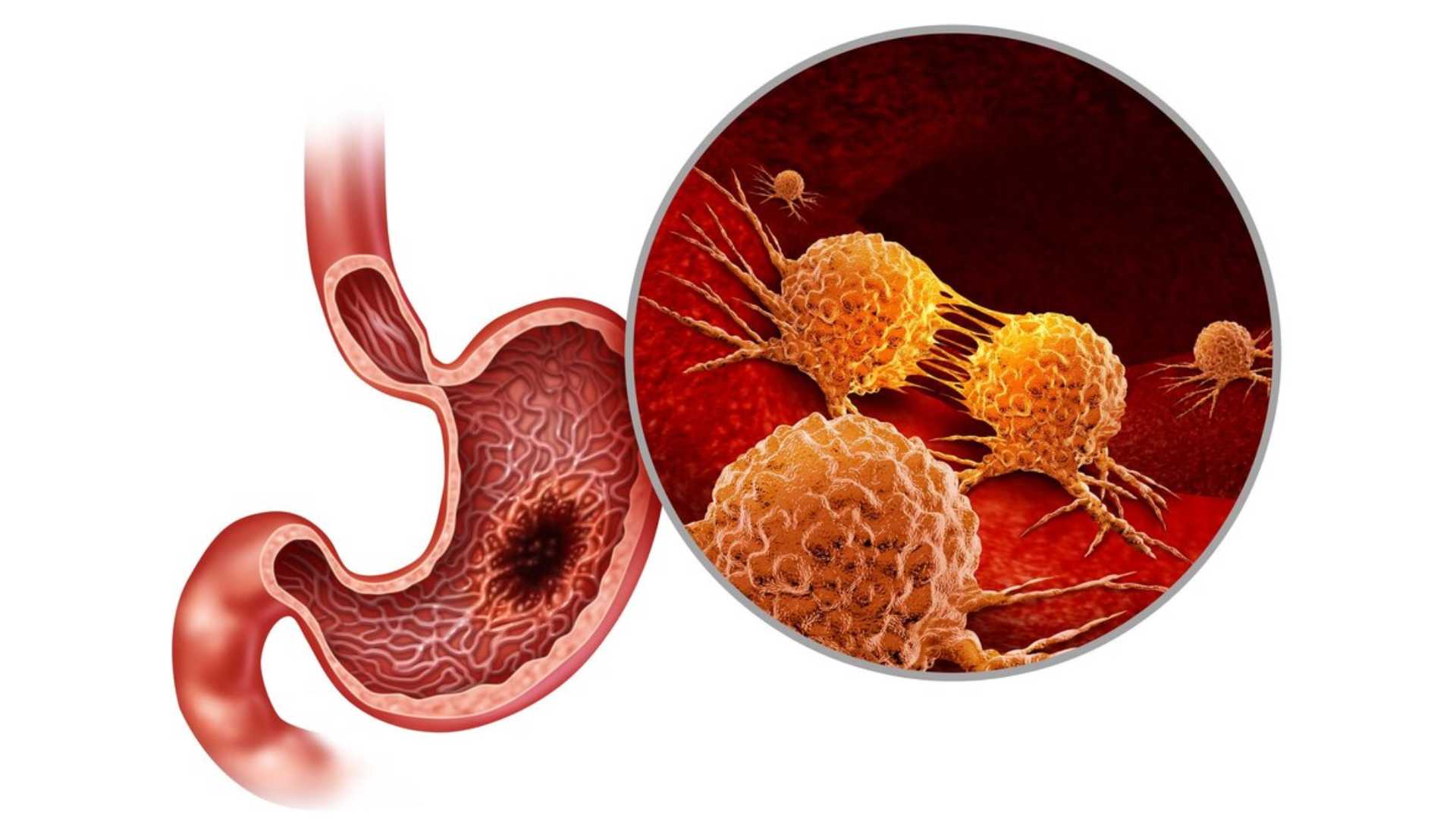 Acid Peptic Disease 