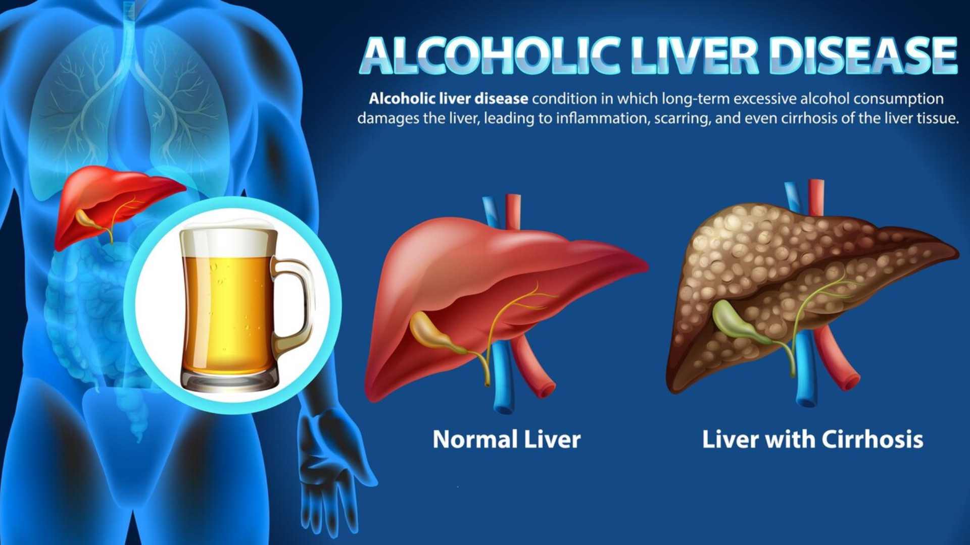 Acid Peptic Disease 
