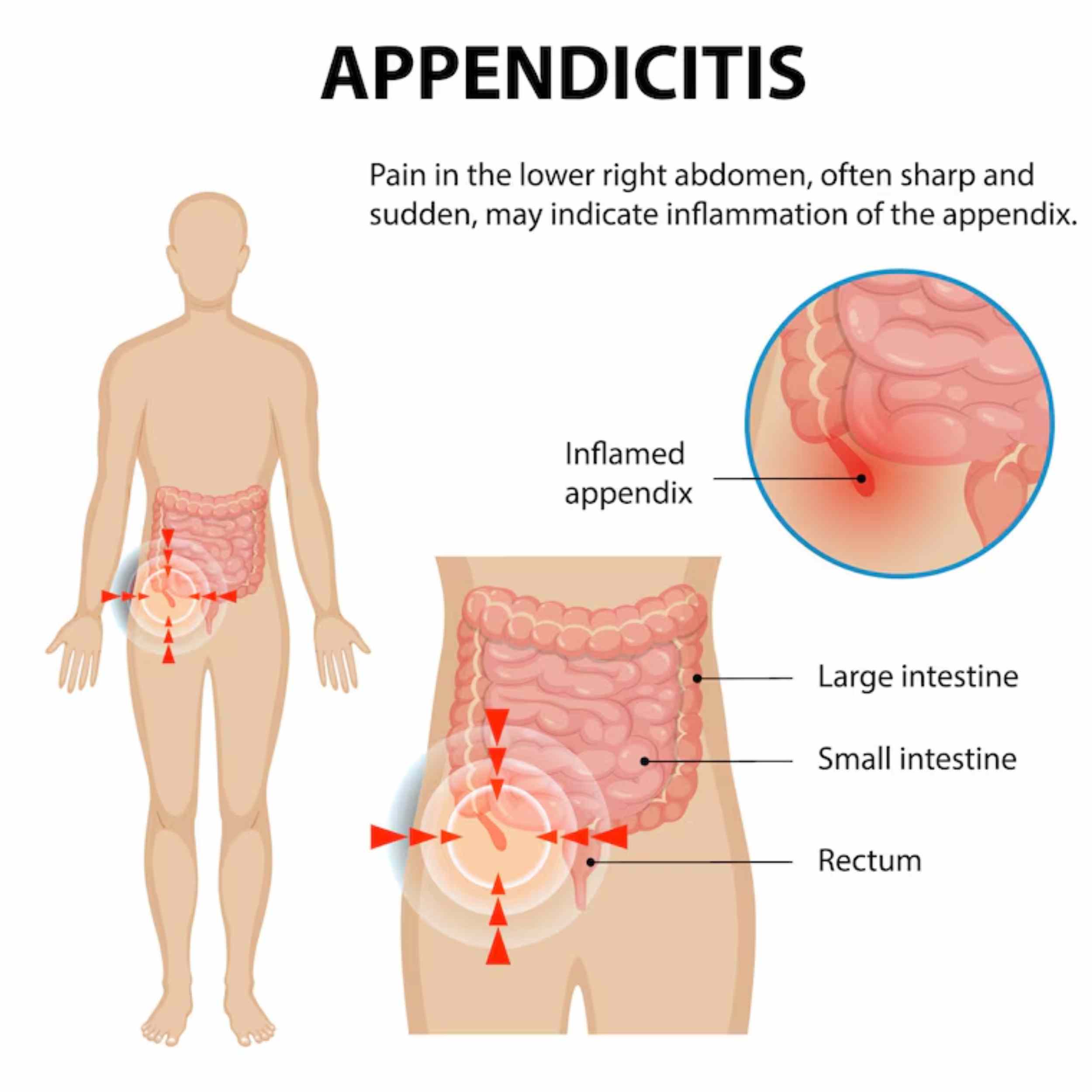 Acid Peptic Disease