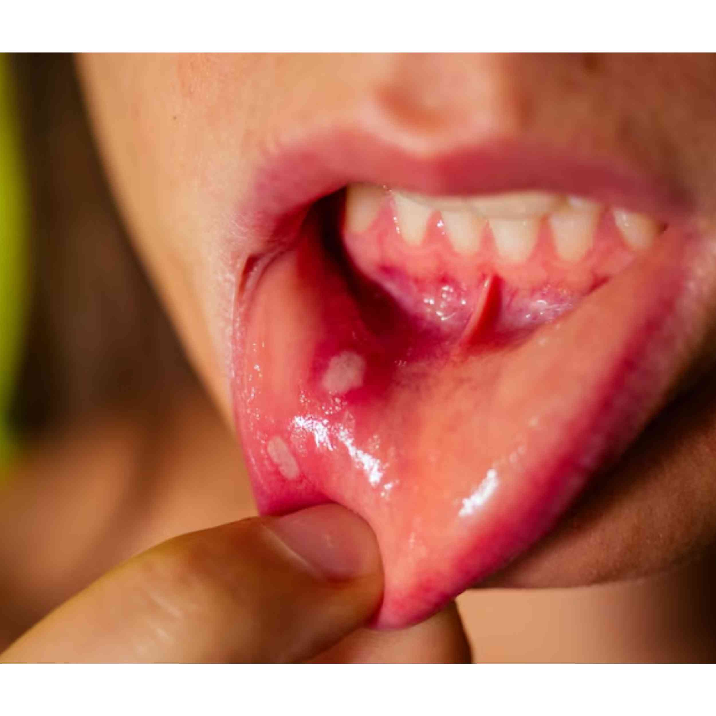 Acid Peptic Disease