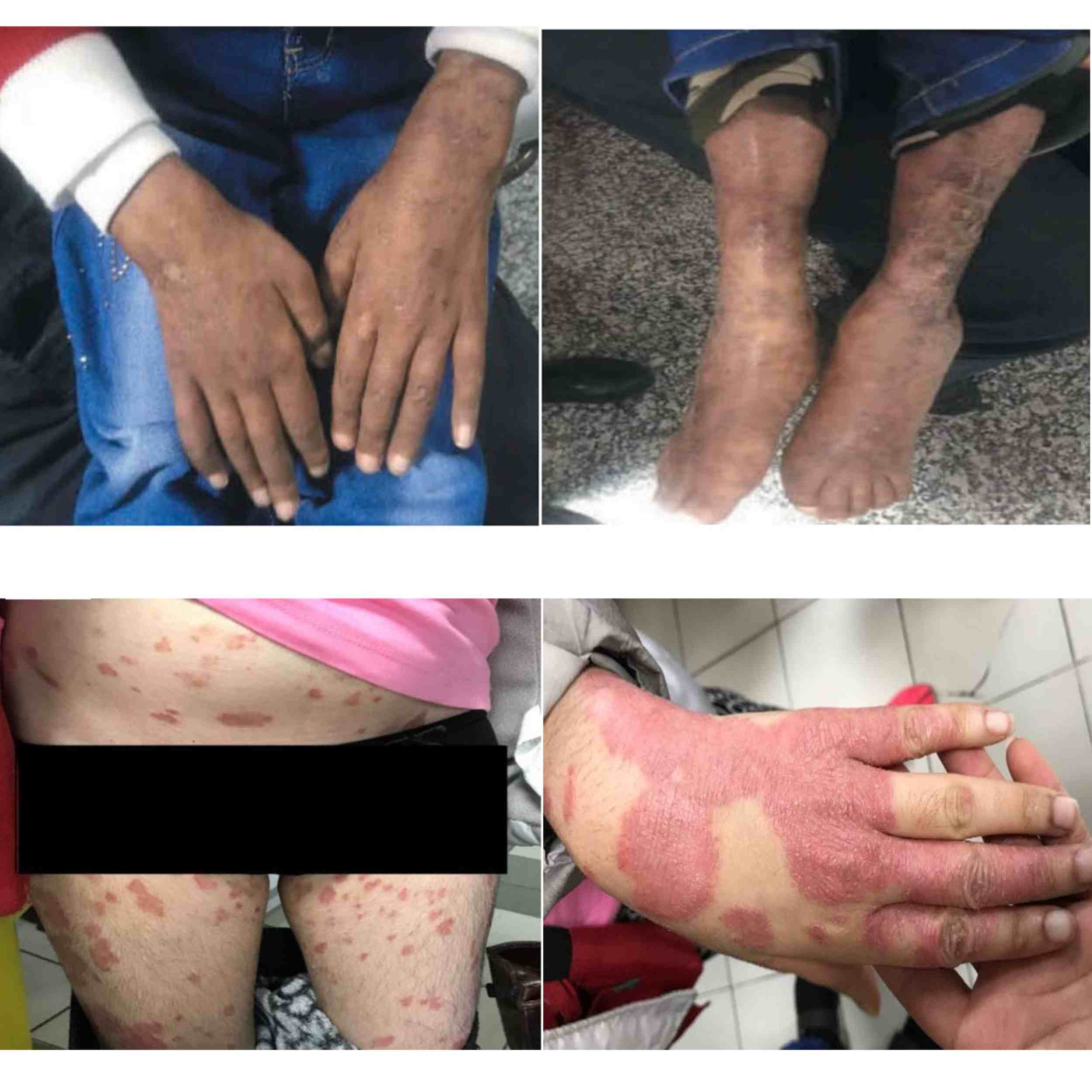 Acid Peptic Disease