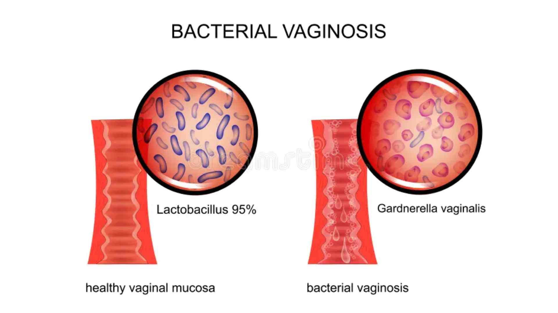 Acid Peptic Disease