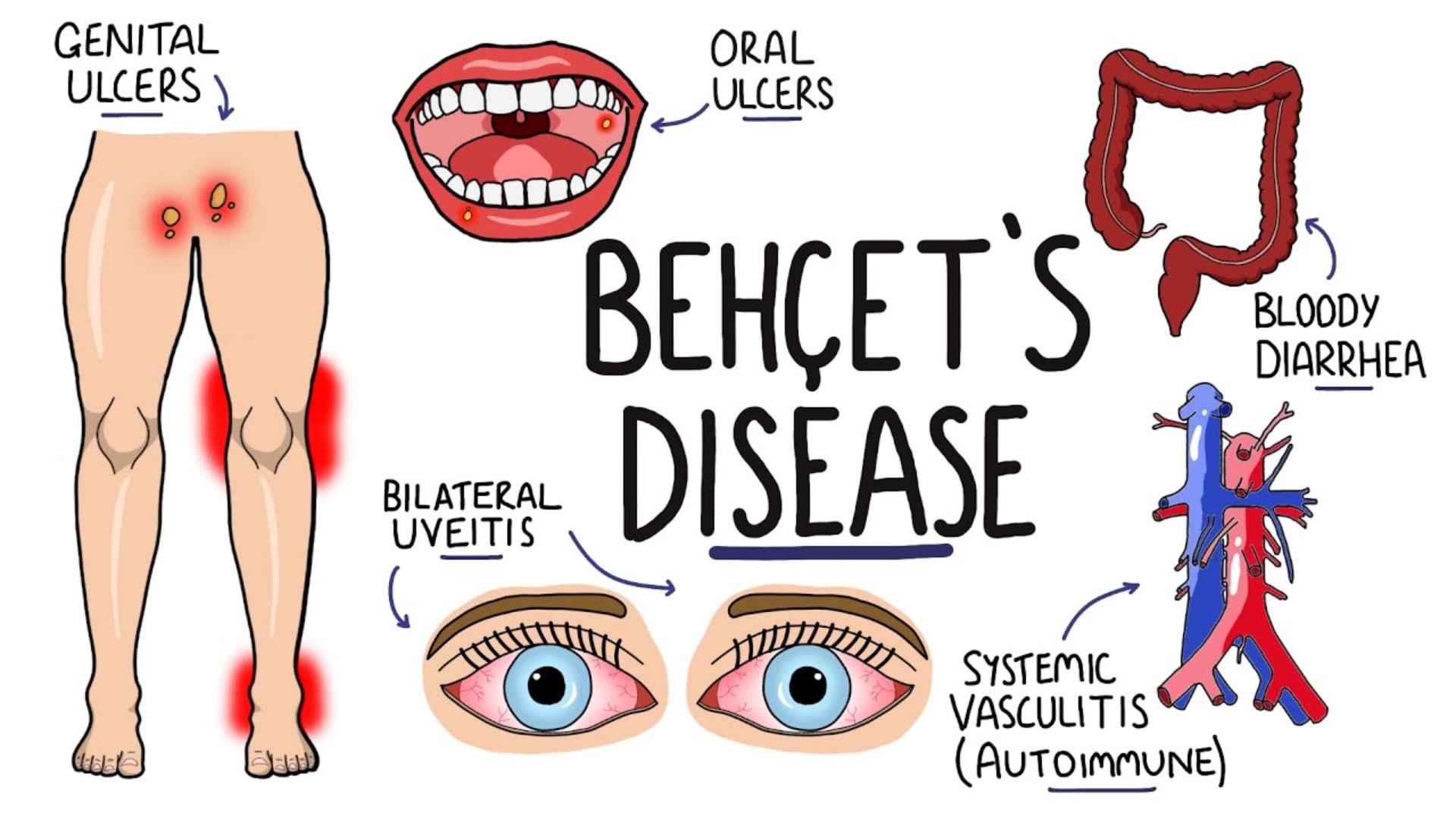Acid Peptic Disease 