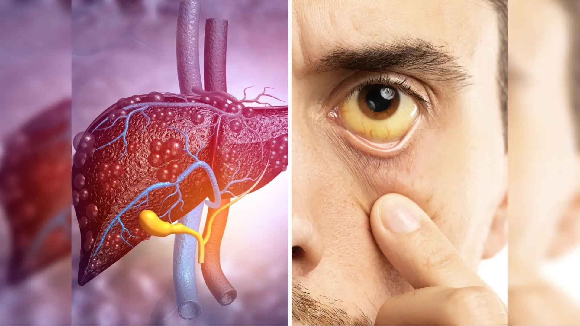 Acid Peptic Disease 