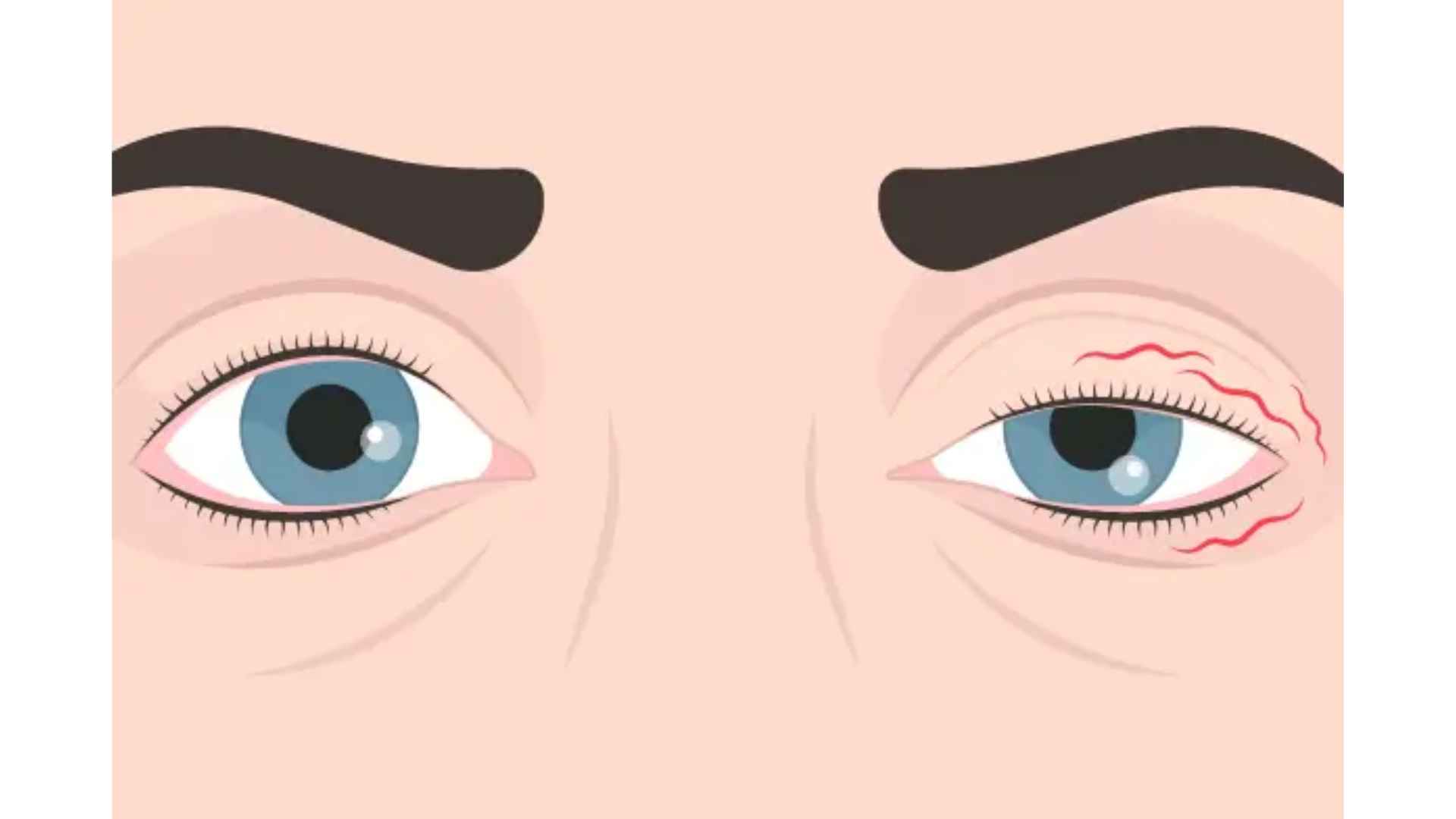 Acid Peptic Disease 