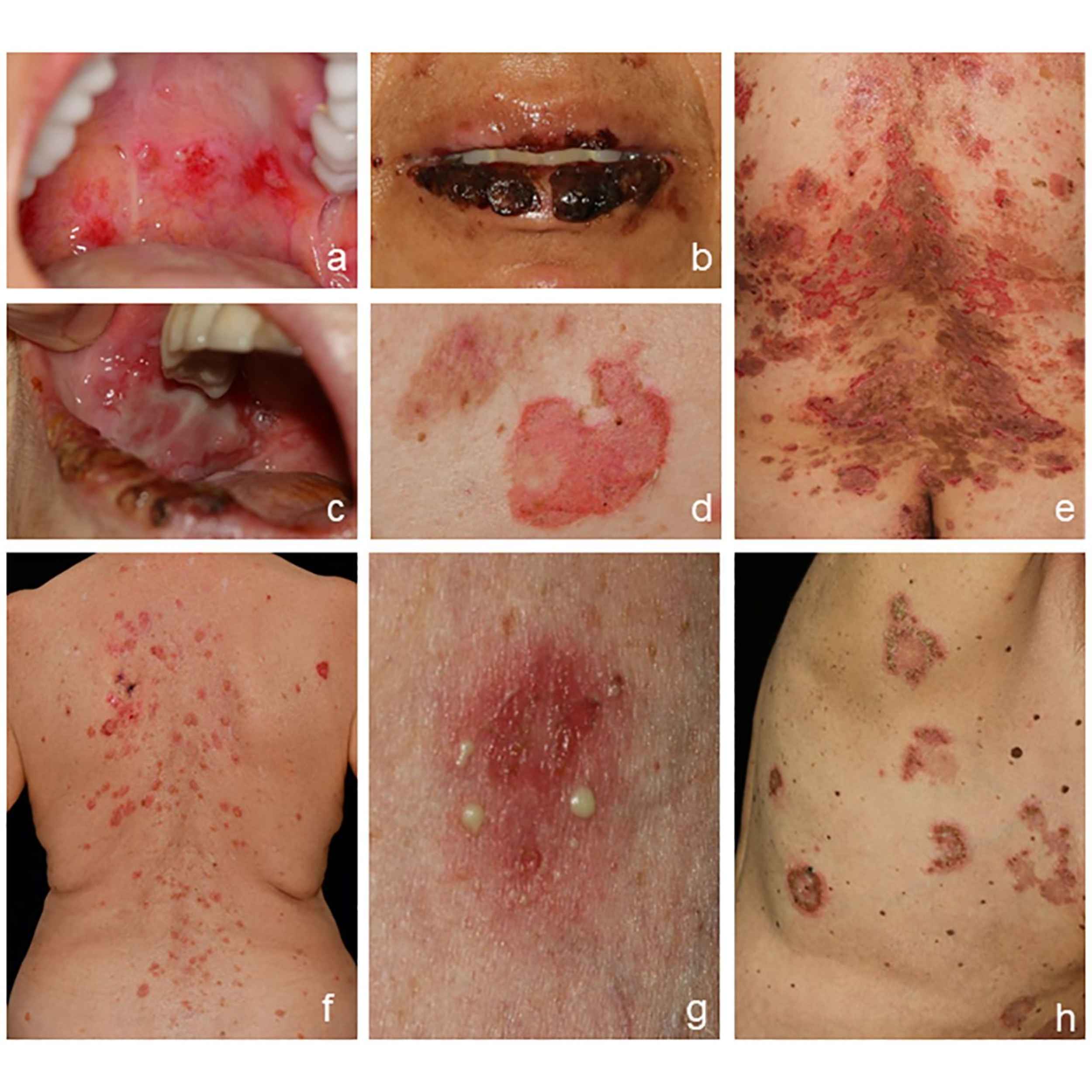 Acid Peptic Disease 