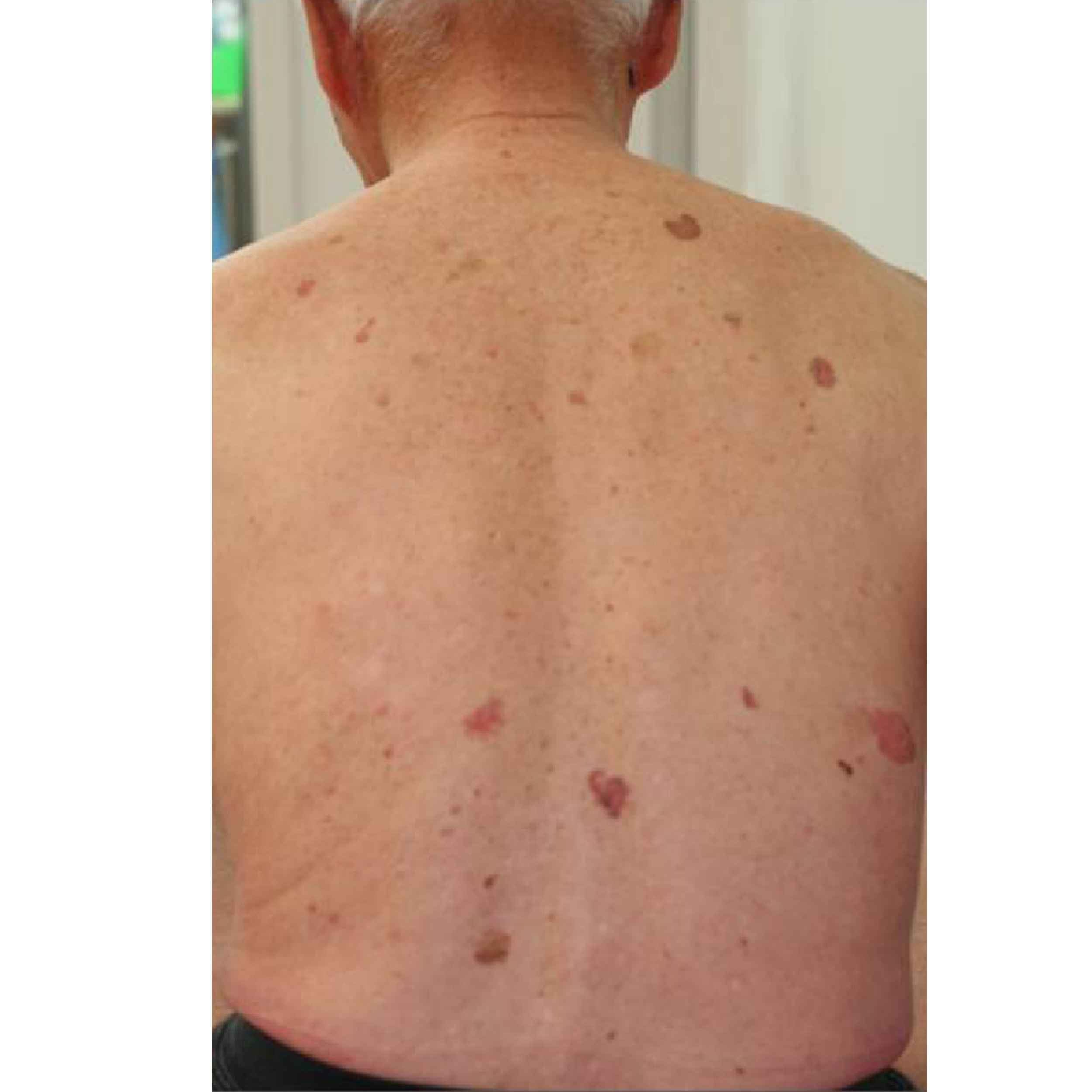 Acid Peptic Disease 