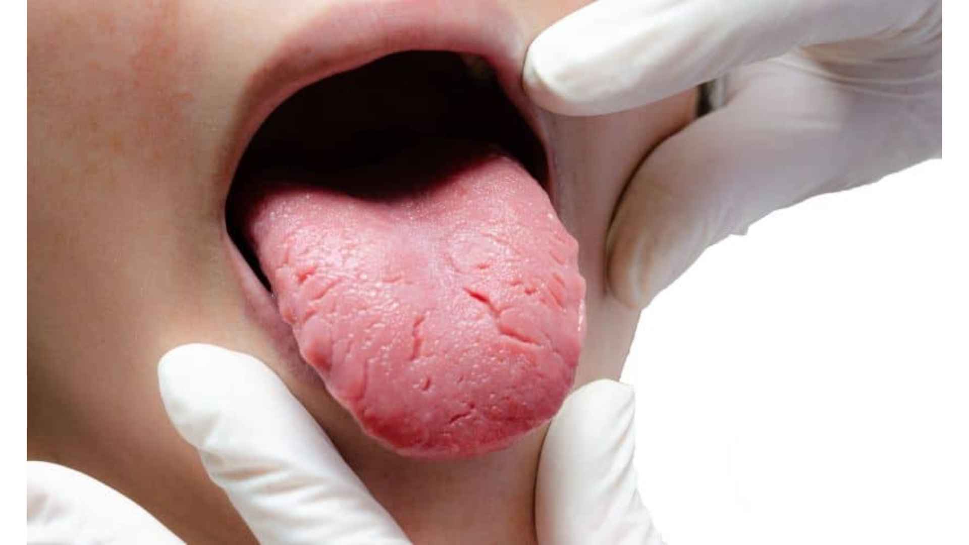 Acid Peptic Disease 