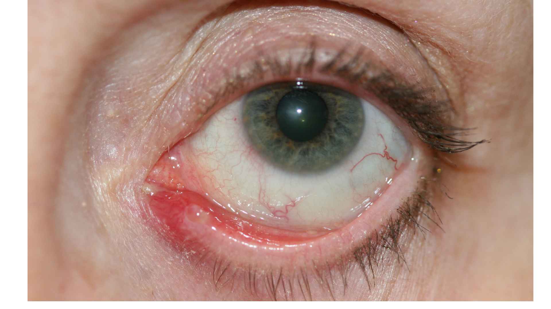 Acid Peptic Disease