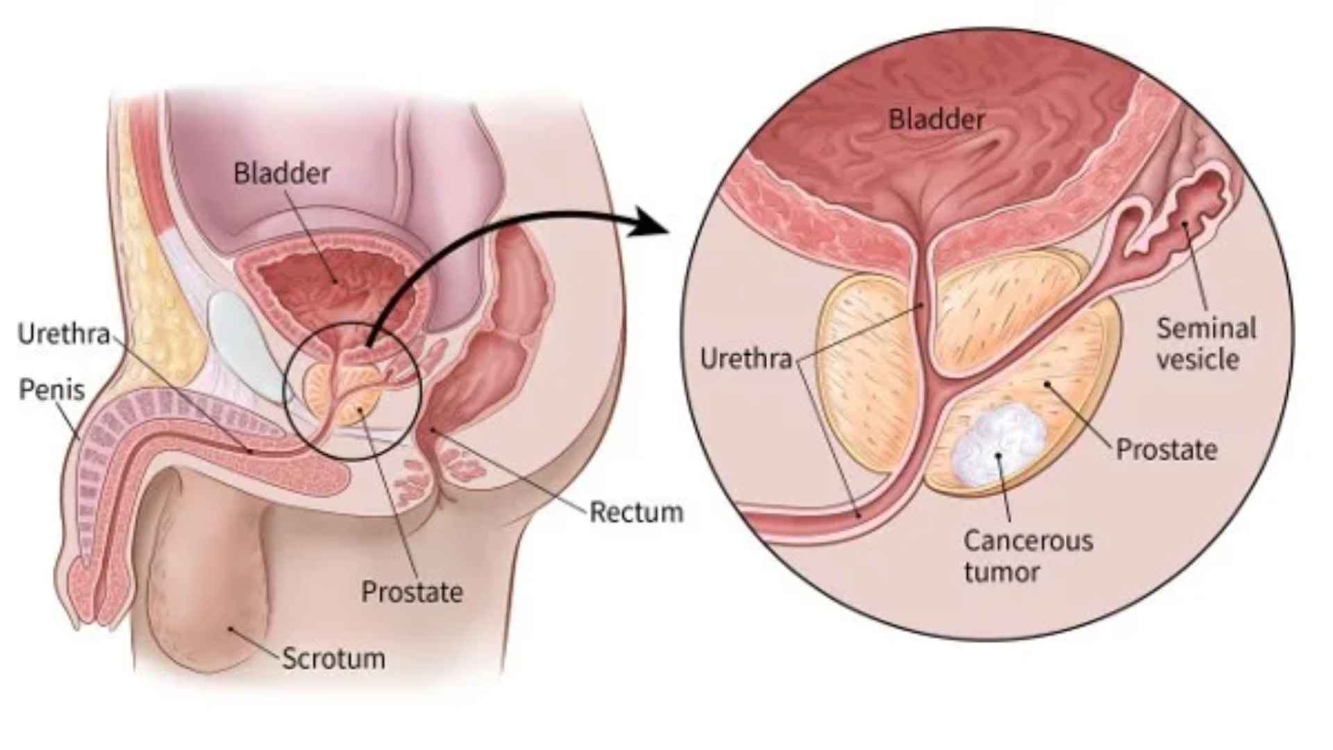 Acid Peptic Disease 