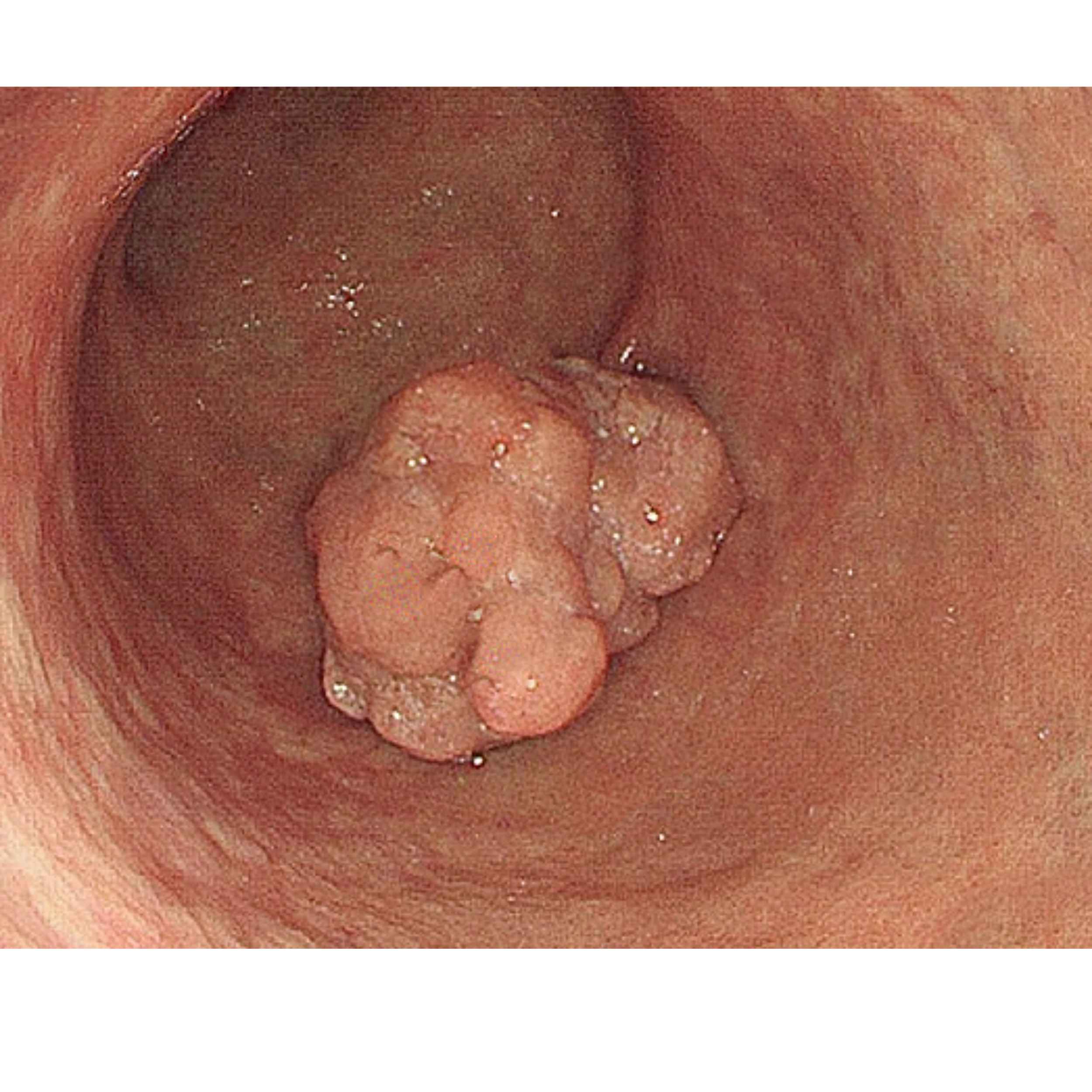 Acid Peptic Disease