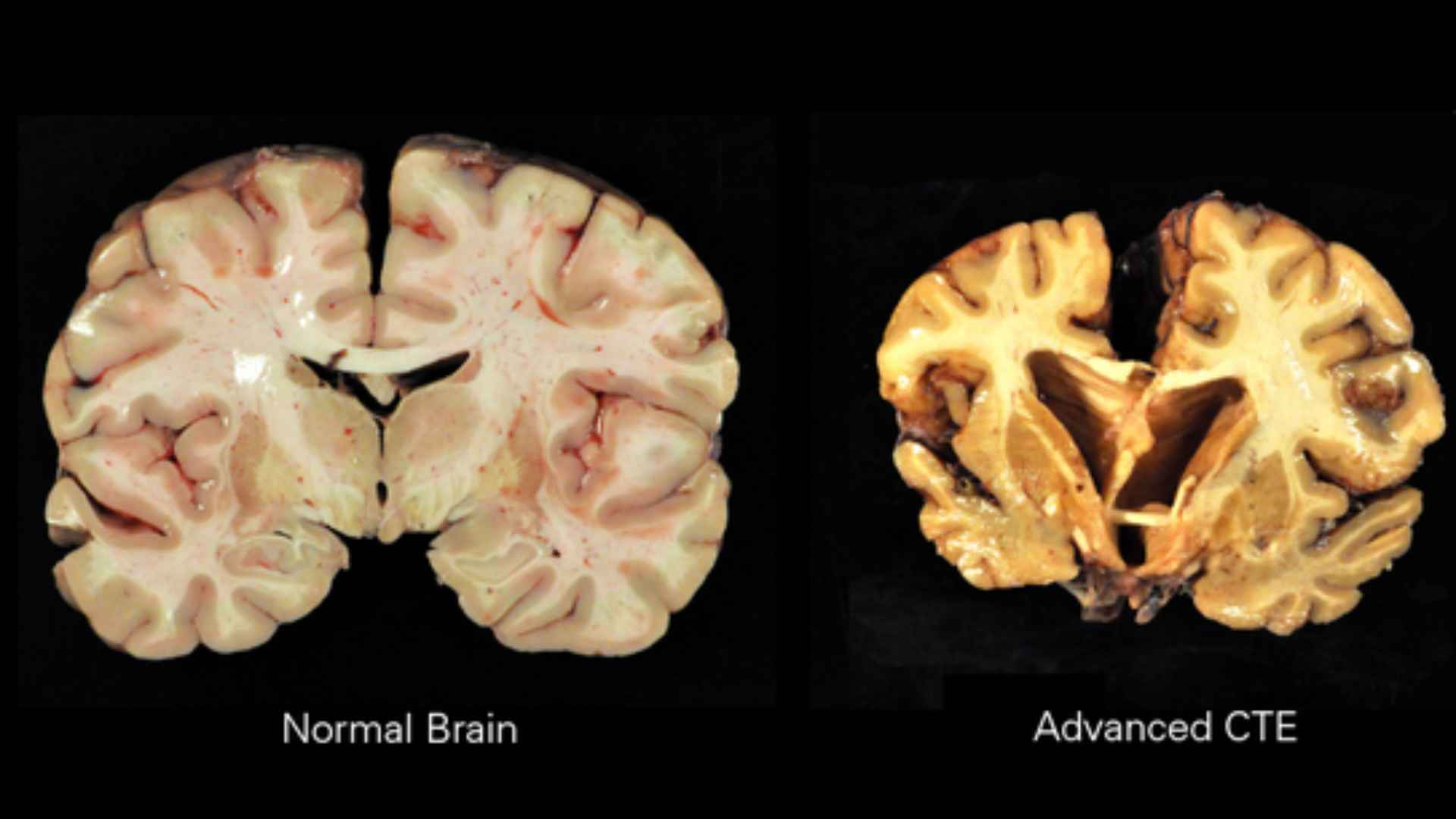 Acid Peptic Disease 