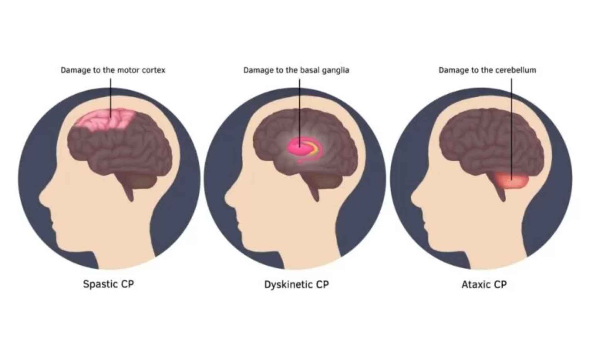 Acid Peptic Disease 