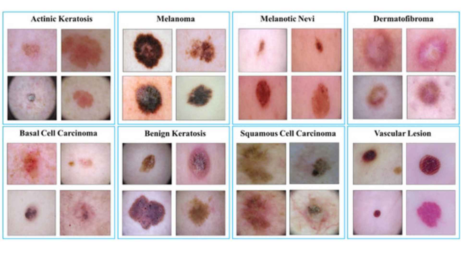 Acid Peptic Disease