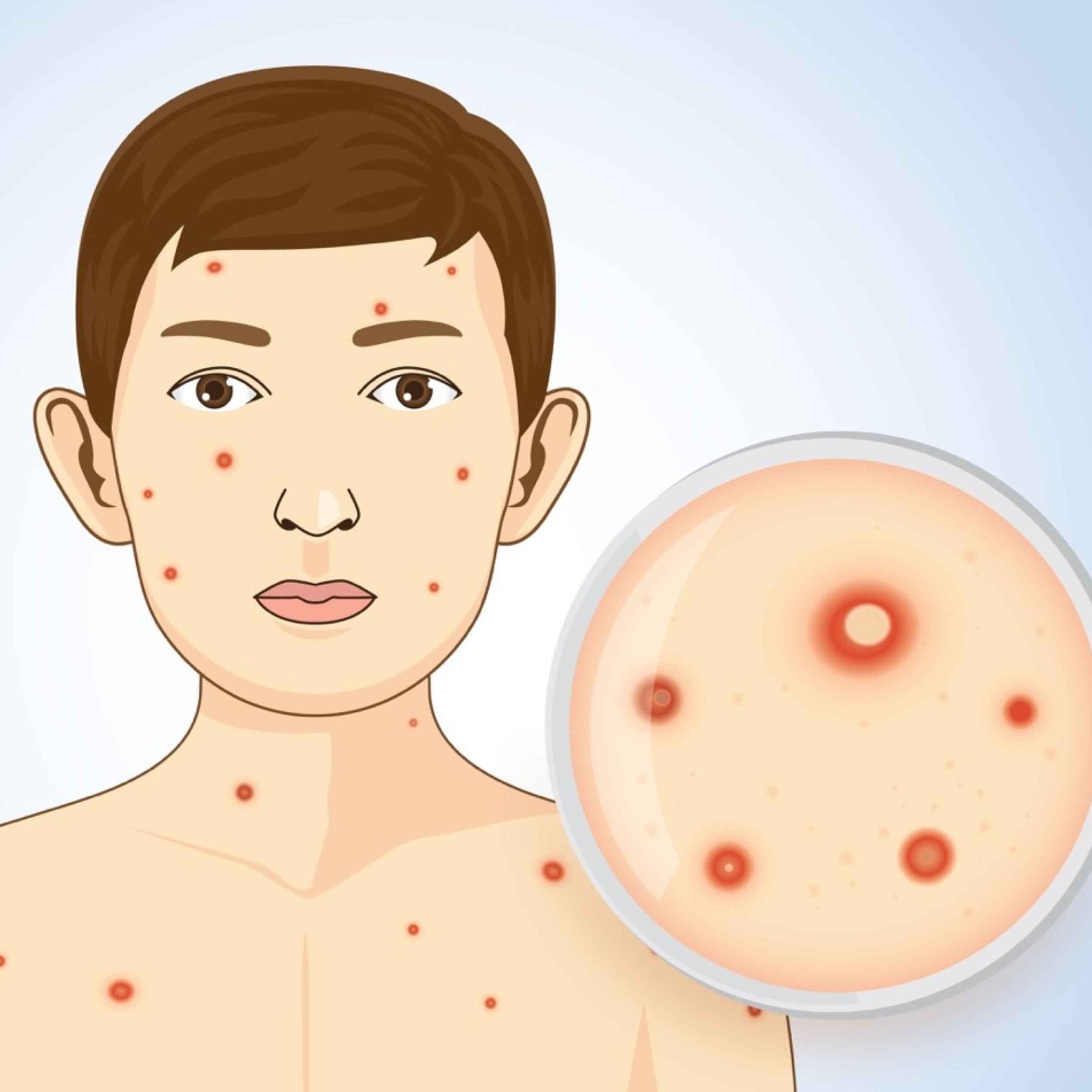 Acid Peptic Disease 