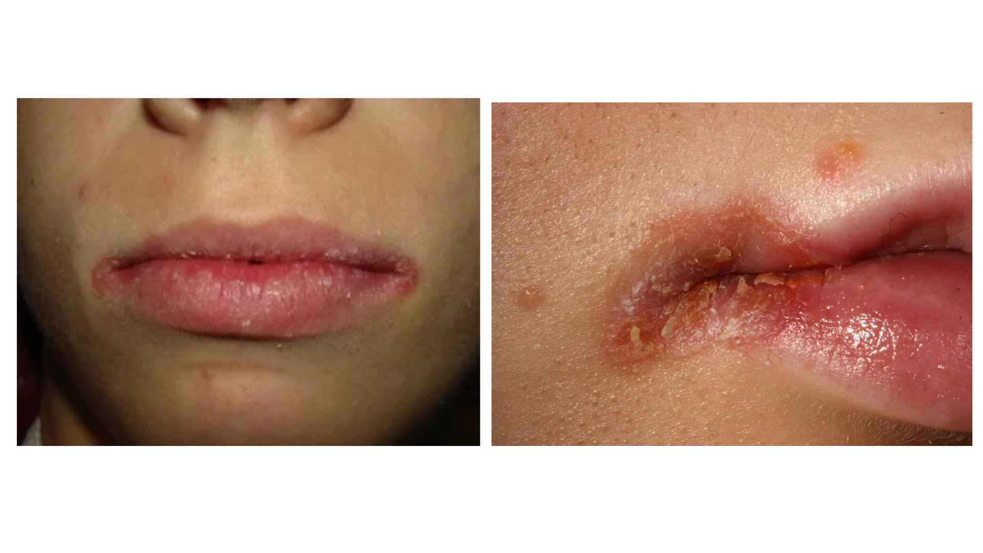 Acid Peptic Disease