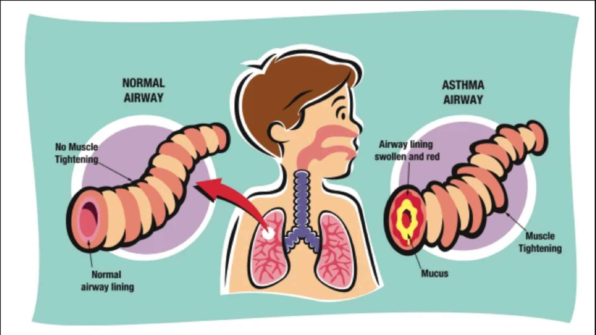 Acid Peptic Disease 