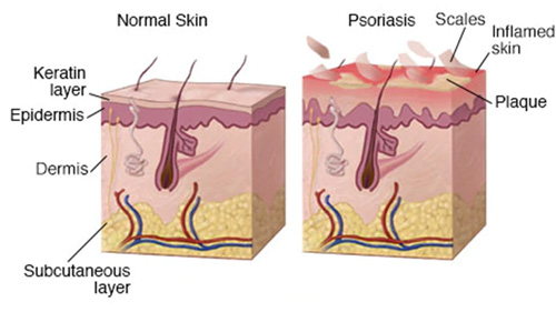 Psoriasis