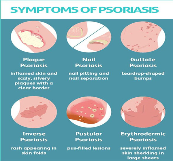 psoriasis Symptoms