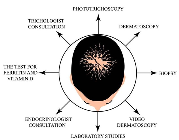 alopecia_areata_diagonsis