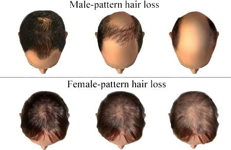 alopecia_areata_symptoms