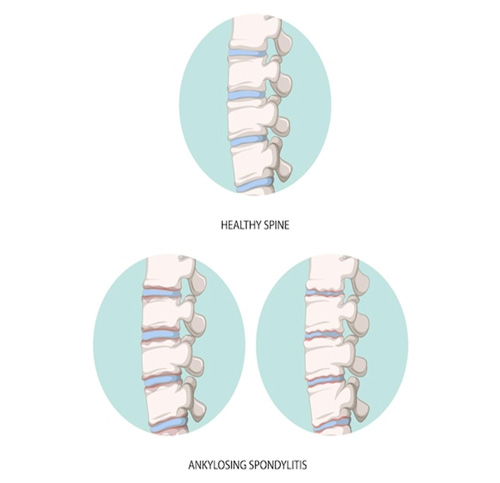 Ankylosing Spondylitis