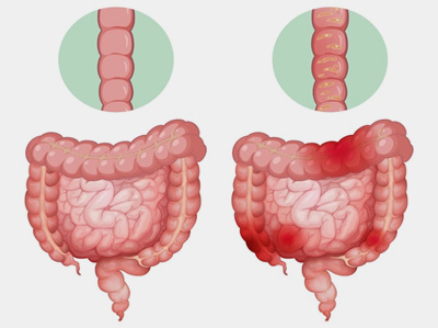 ankylosing spondylitis