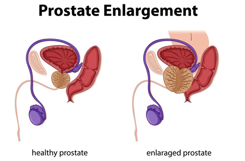 Benign Prostatic Hyperplasia