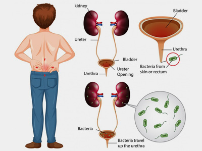 Benign Prostatic Hyperplasia