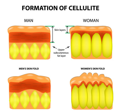 Symptoms of Cellulitis