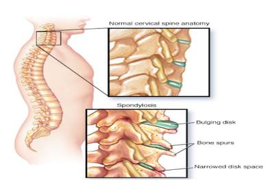 cervical spondylosis