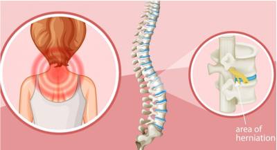 cervical spondylosis