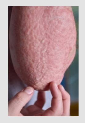 eczema