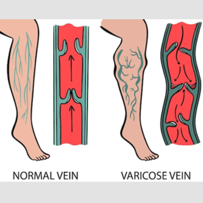 eczema