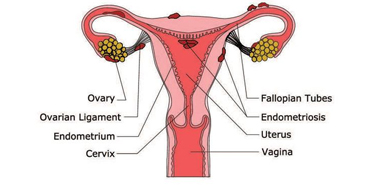 Endometriosis