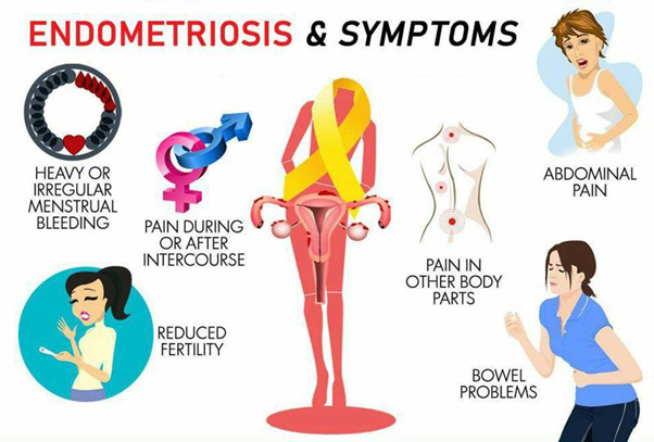 Endometriosis