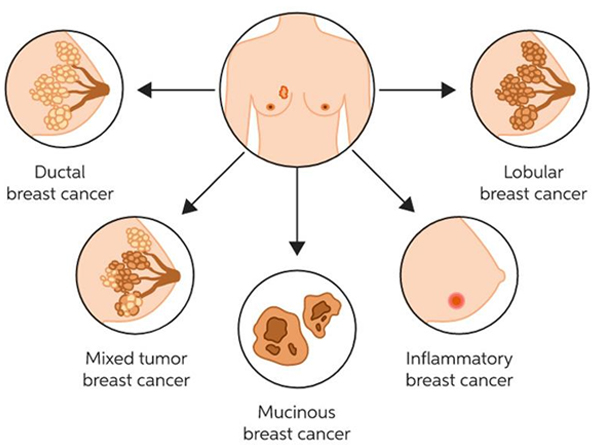 Fibrocystic breast disease Causes