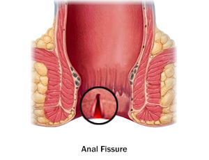 fissure