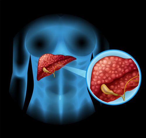 Gallstone