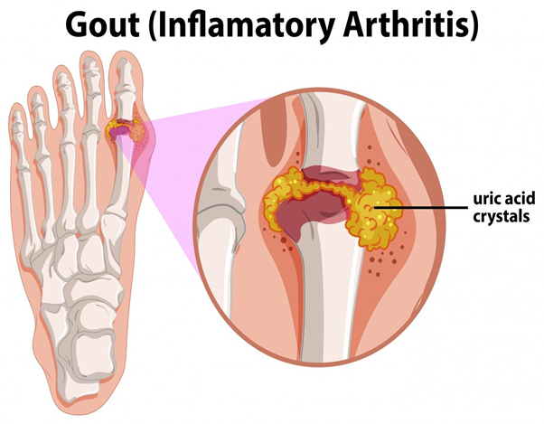 gout_causes