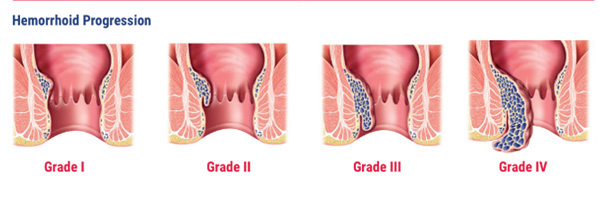 hemorrhoid