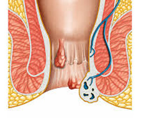 hemorrhoid Causes