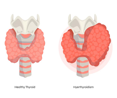 Hyperthyroidism