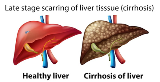 Liver Cirrhosis