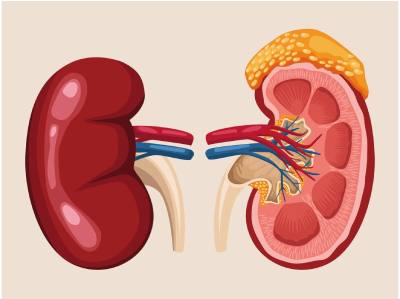 Kidney Failure