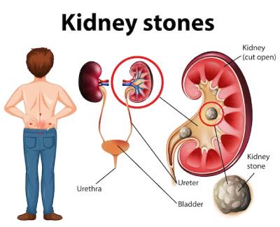 Kidney Stone