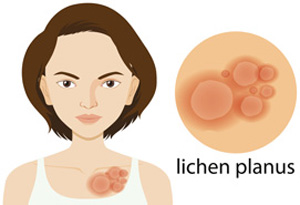 lichen planus