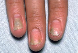 lichen planus symptom